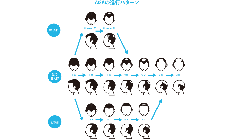 AGAにおける脱毛パターン：【頭頂部】ⅡVertex型→ⅢVertex型（Ⅳ型と合流）　【髪の生え際】Ⅰ型→Ⅱ型→Ⅲ型→Ⅳ型→Ⅴ型→Ⅵ型→Ⅶ型　【前頭部】Ⅱa→Ⅲa→Ⅳa→Ⅴa（Ⅵ型と合流）