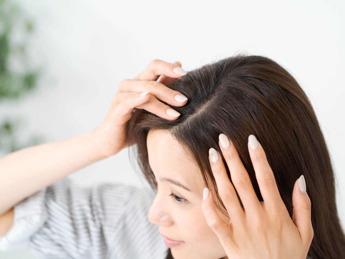 分け目はげを治したい！原因や治し方を詳しく解説